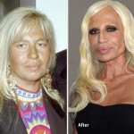 Donatella Versace before and after plastic surgery 07
