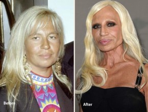Donatella Versace before and after plastic surgery 07