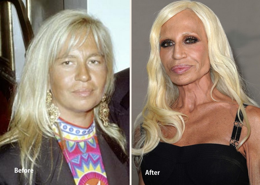 Donatella Versace before and after plastic surgery 07.