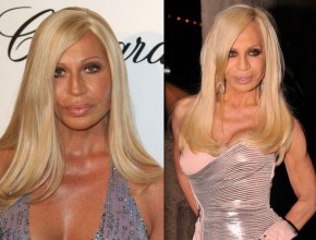 Donatella Versace before and after plastic surgery 08