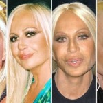 Donatella Versace plastic surgery transformations