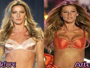 Gisele Bundchen before and after breast augmentation