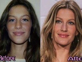 Gisele Bundchen before and after plastic surgery