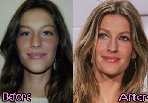 Gisele Bundchen before and after plastic surgery