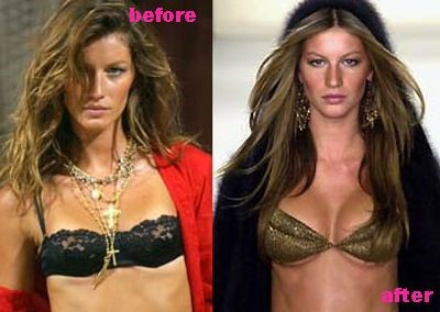 Gisele Bundchen before and after plastic surgery