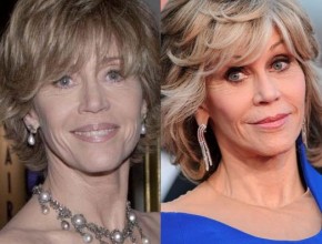Jane Fonda before and after plastic surgery