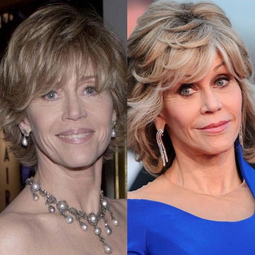 Jane Fonda before and after plastic surgery