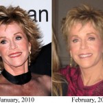 Jane Fonda before and after plastic surgery 02