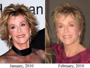 Jane Fonda before and after plastic surgery 02