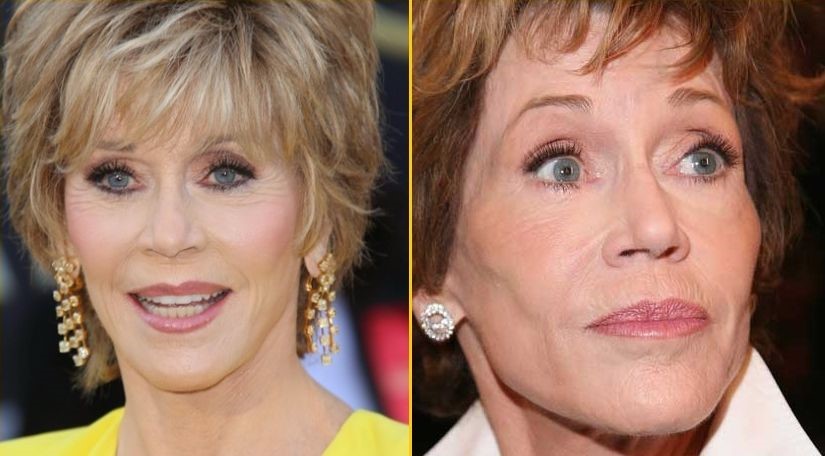 Jane Fonda Before And After Plastic Surgery Celebrity Plastic Surgery ...