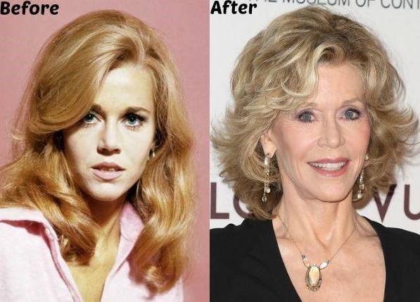 Jane Fonda before and after plastic surgery