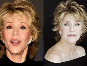 Jane Fonda before and after plastic surgery 05