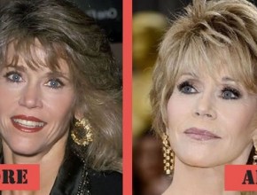 Jane Fonda before and after plastic surgery 06