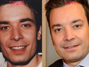 Jimmy Fallon before and after plastic surgery 01