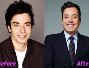 Jimmy Fallon before and after plastic surgery