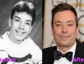 Jimmy Fallon before and after plastic surgery 04
