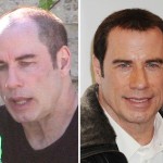 John Travolta before and after hair implant