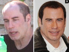 John Travolta before and after hair implant