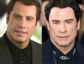John Travolta before and after plastic surgery 02