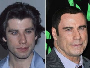 John Travolta before and after plastic surgery 03