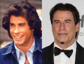 John Travolta before and after plastic surgery