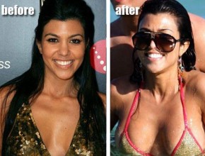 Kourtney Kardashian before and after plastic surgery