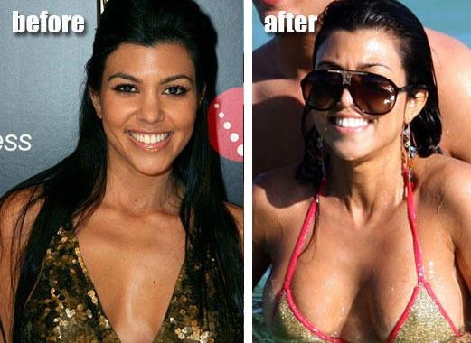 Kourtney Kardashian before and after plastic surgery