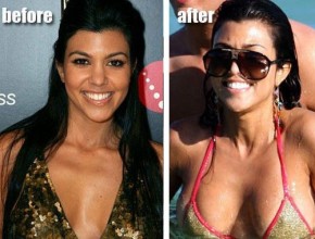 Kourtney Kardashian before and after plastic surgery 02
