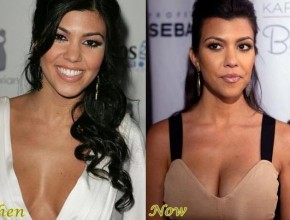 Kourtney Kardashian before and after plastic surgery