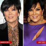 Kris Jenner before and after plastic surgery 01