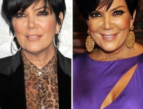 Kris Jenner before and after plastic surgery 01