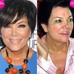 Kris Jenner before and after plastic surgery 03