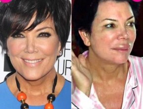 Kris Jenner before and after plastic surgery 03