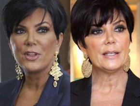 Kris Jenner before and after plastic surgery 04