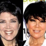 Kris Jenner before and after plastic surgery 05