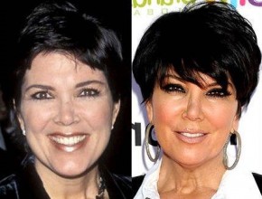 Kris Jenner before and after plastic surgery 05
