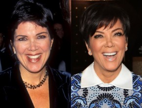 Kris Jenner before and after plastic surgery