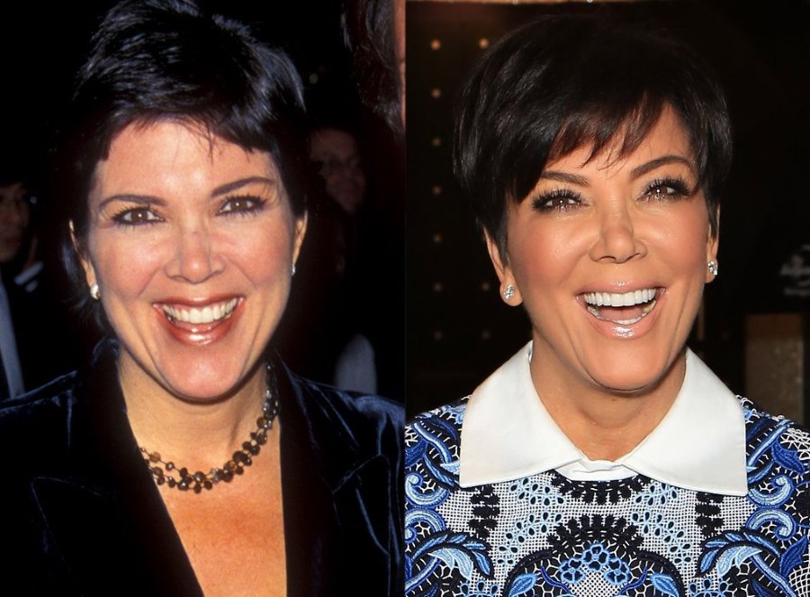 Kris Jenner before and after plastic surgery