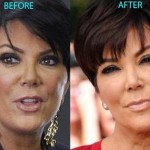 Kris Jenner before and after using botox