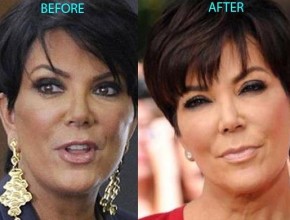 Kris Jenner before and after using botox