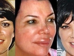 Kris Jenner before, during and after plastic surgery