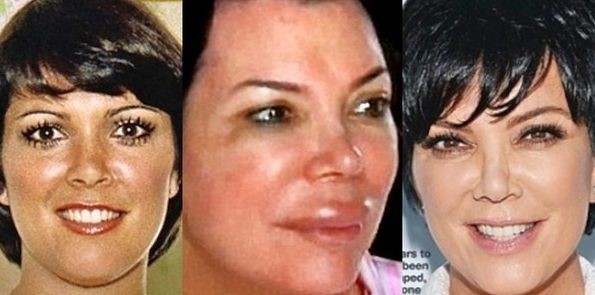 Kris Jenner before, during and after plastic surgery