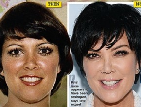 Kris Jenner then and now after plastic surgery