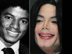 Michael Jackson before and after plastic surgery 03