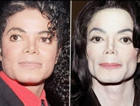 Michael Jackson before and after plastic surgery (2)