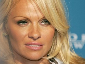 Pamela Anderson after botox injections