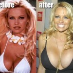 Pamela Anderson before and after breast augmentation 02