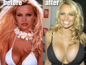 Pamela Anderson before and after breast augmentation 02