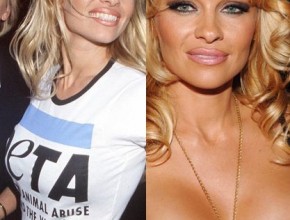 Pamela Anderson before and after breasts augmentation 03