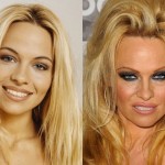 Pamela Anderson before and after plastic surgery 02